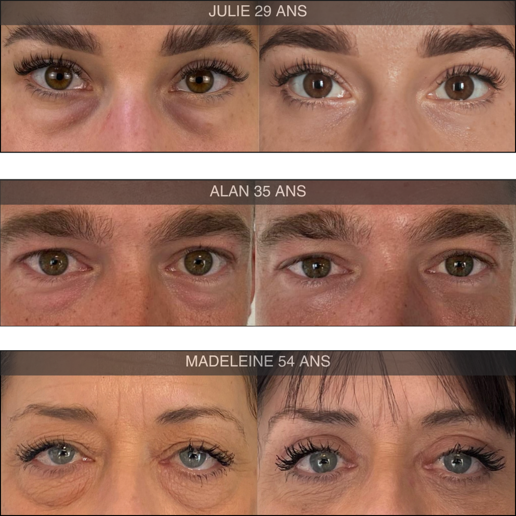 Patchs Anti-cernes microneedling
