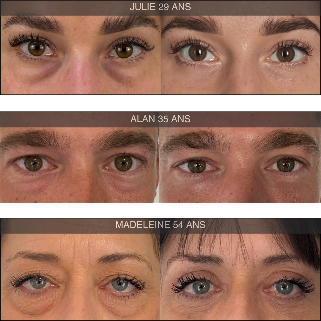 Patchs Anti-cernes microneedling